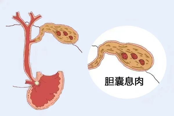 體檢出膽囊息肉，需要擔心嗎？