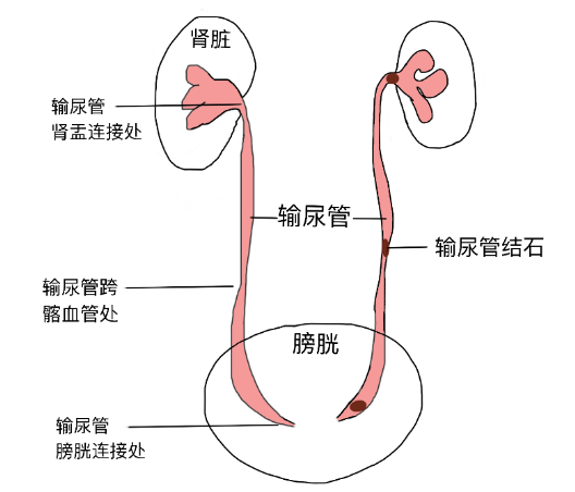結石引發劇烈腎絞痛，該怎么辦？