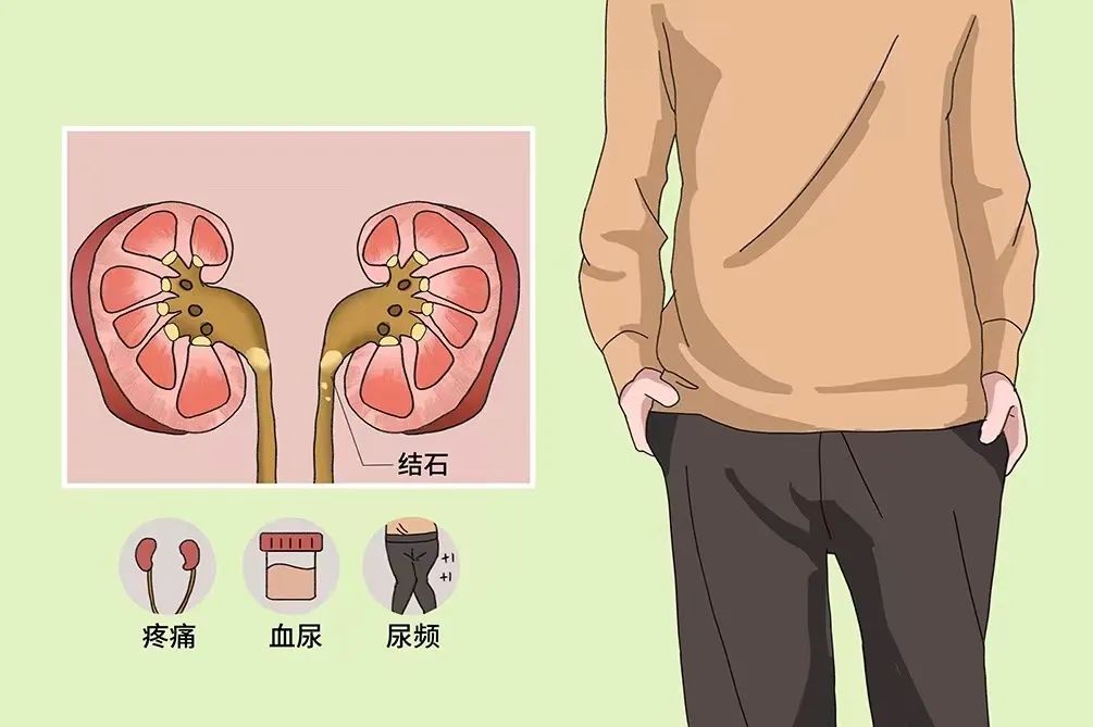 為什么很多人得腎結(jié)石？有2個習(xí)慣不要碰，腎會感激你