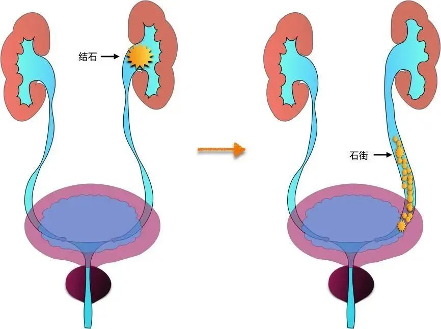 你經(jīng)歷過(guò)腎絞痛嗎？該如何緩解治療？