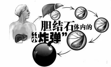膽囊里的小結石要緊嗎？長大后再處理行不行？