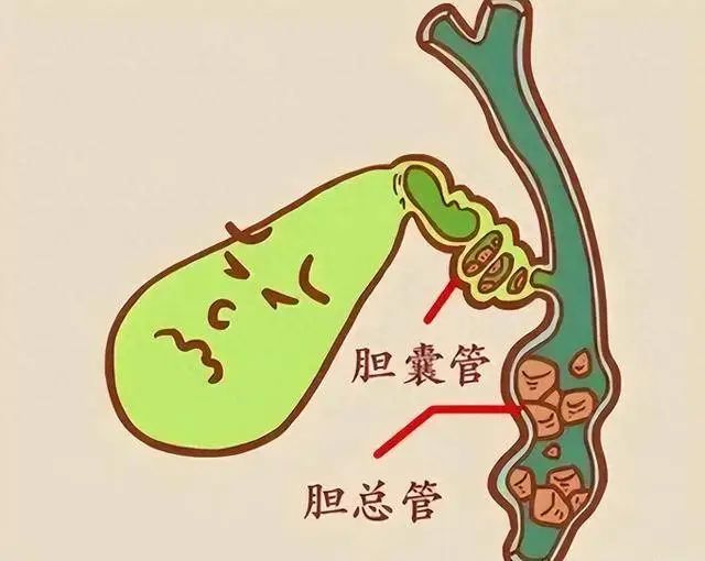 膽囊增大別視若無睹，可能背后潛伏了這幾頭“狼”！
